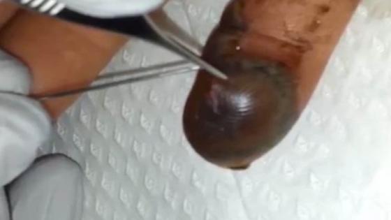 فيديو | لقطات مروعة تظهر ذوبان لحم الأصبع بسبب لدغة ثعبان سام